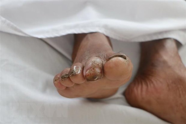 Bệnh nhân có tiền sử bị bệnh đái tháo đường type II, biến chứng loét ngón 2 bàn chân phải mà vẫn làm việc đồng áng và tiếp xúc với bùn đất mà không có phương tiện bảo hộ nên đã bị vi khuẩn Burkholderia pseudomallei xâm nhập qua vết loét.
