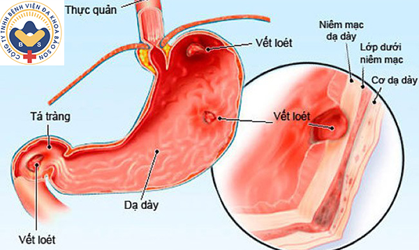 Viêm loét dạ dày tá tràng