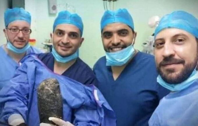 Các bác sĩ tại bệnh viện ở thủ đô Amman, Jordan cầm búi tóc được lấy khỏi bụng bệnh nhân 20 tuổi sau ca phẫu thuật tuần trước. Ảnh: Gulf News.
