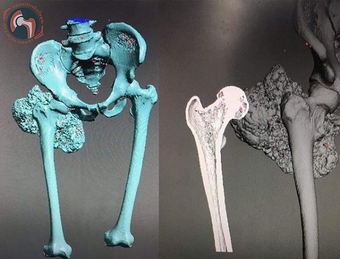 Các kỹ sư tạo ra mô hình xương nhân tạo in 3D từ bản quét cắt lớp vi tính của bệnh nhân
