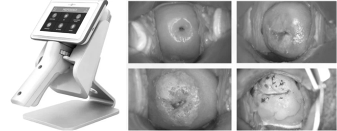 Kỹ thuật soi cổ tử cung có tích hợp AI lần đầu được ứng dụng tại Việt Nam