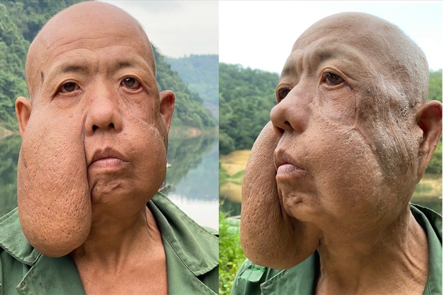 Bệnh nhân Thào A Tu với khối u khổng lồ trên mặt.