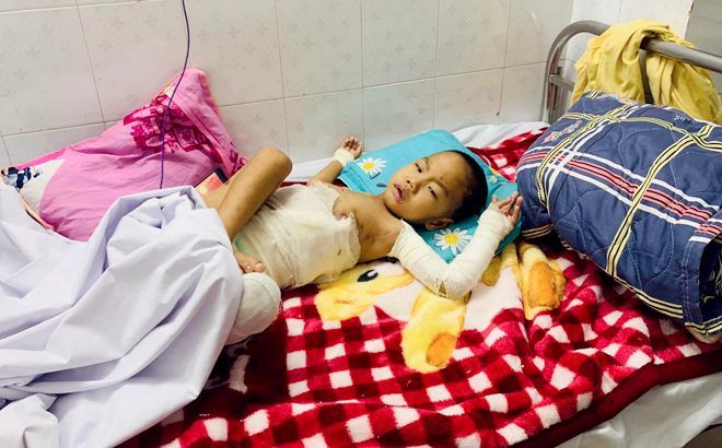 Bé Lục Duy Cương đang điều trị bỏng tại Bệnh viện Bỏng Quốc gia.
