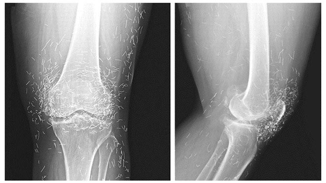 Phim chụp X-quang cho thấy, đầu gối của người bệnh có hàng trăm kim châm cứu bằng vàng