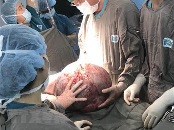 Các bác sỹ phẫu thuật bóc tách khối u buồng trứng khổng lồ.