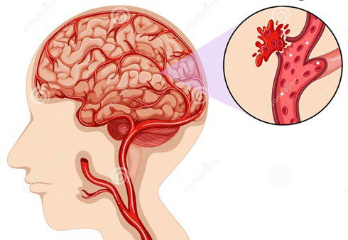 3. Điều trị phục hồi sau xuất huyết não