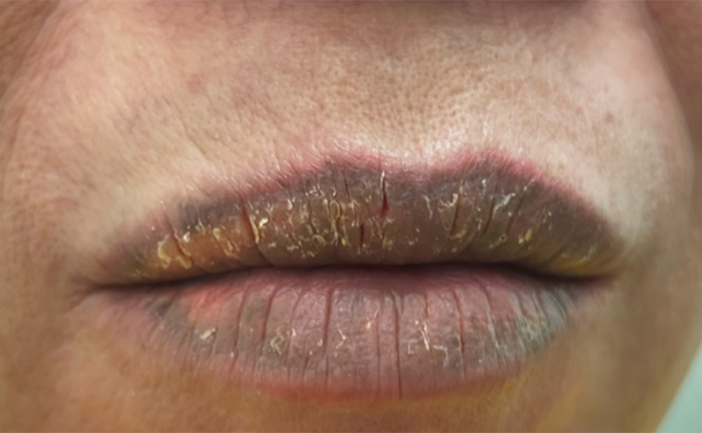 Bệnh nhân bị khô môi, đóng vảy và đặc biệt bị tăng sắc tố vùng môi nhiều sau xăm môi.
