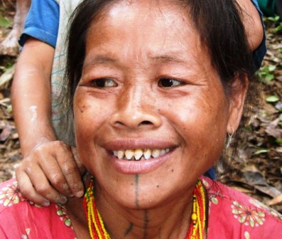 Người phụ nữ với hàm răng sau khi đã được mài