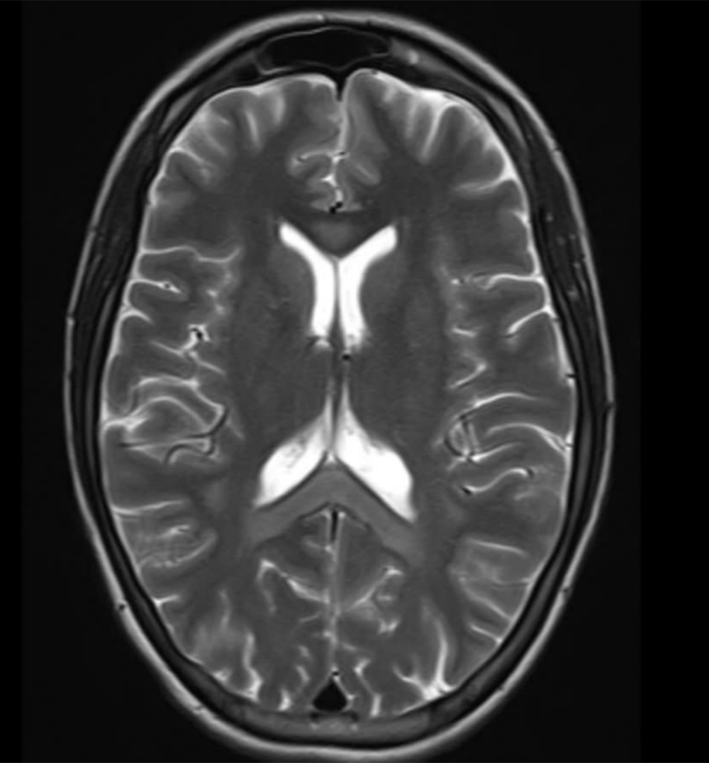 Hình ảnh chụp MRI sọ não bệnh nhân nữ bị tổn thương lan tỏa hai bán cầu và thể chai.