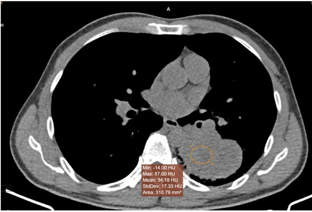 Chụp cắt lớp vi tính đa dãy (MSCT) ghi nhận hình ảnh hướng u phổi trái.