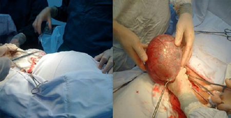 Khối u trước và sau khi mổ của bệnh nhân Nguyễn Thị Ng.