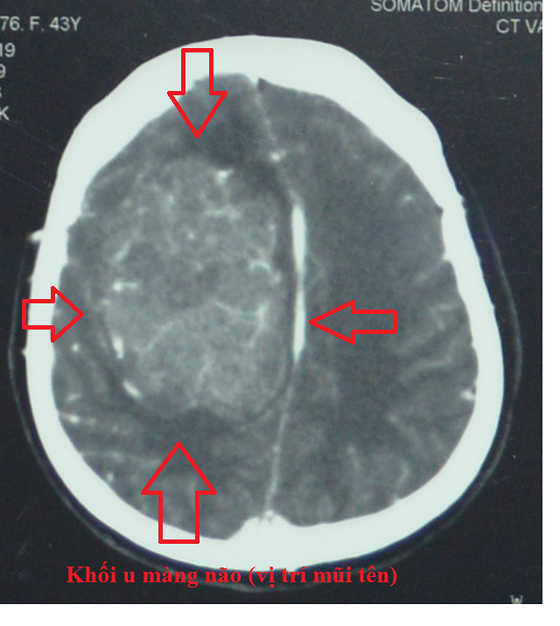 Khối u màng não rất lớn, nguy hiểm