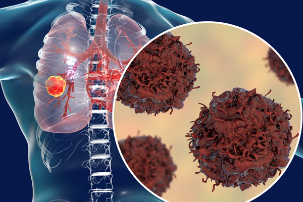Ung thư phổi rất khó phát hiện sớm do dấu hiệu khởi phát nghèo nàn, chụp Xquang thường không phát hiện được khối u kích cỡ nhỏ.