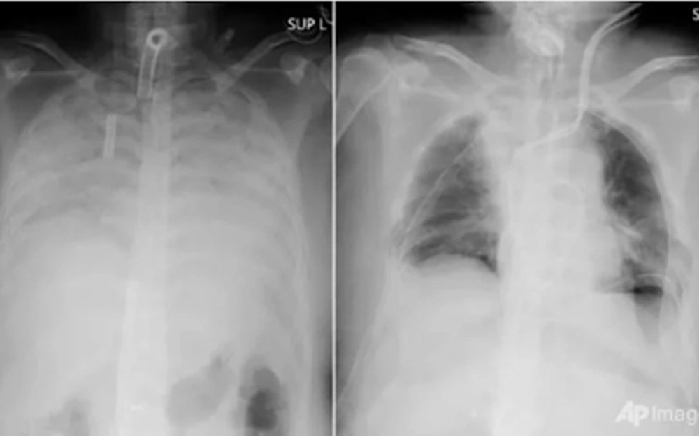Hình ảnh X-quang phổi trắng (Ảnh minh họa)