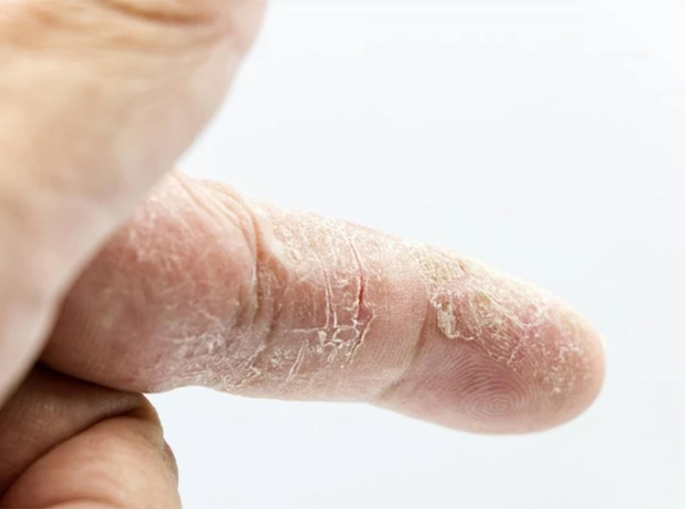 Da khô là một trong những triệu chứng thường gặp của suy giáp