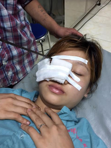 Bệnh nhân Triệu Thị Ngọc bị thanh sắt đâm xuyên qua 1/3 ngoài mi trên mắt phải.
