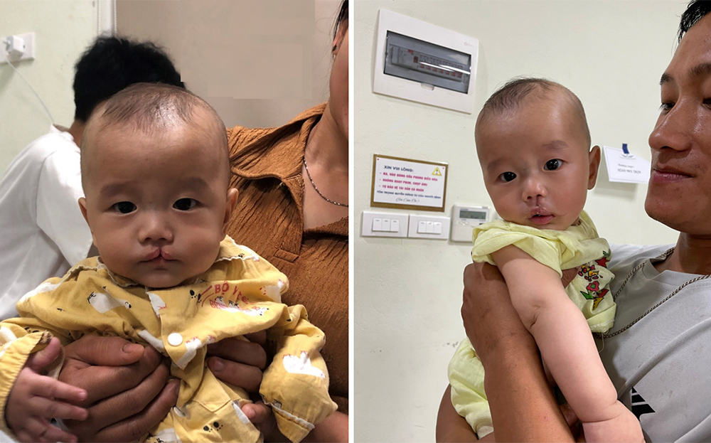 Bé Sùng Anh Dũng, 5 tháng tuổi ở thôn Khe Ron, xã Hồng Ca, huyện Trấn Yên trước và sau khi phẫu thuật.