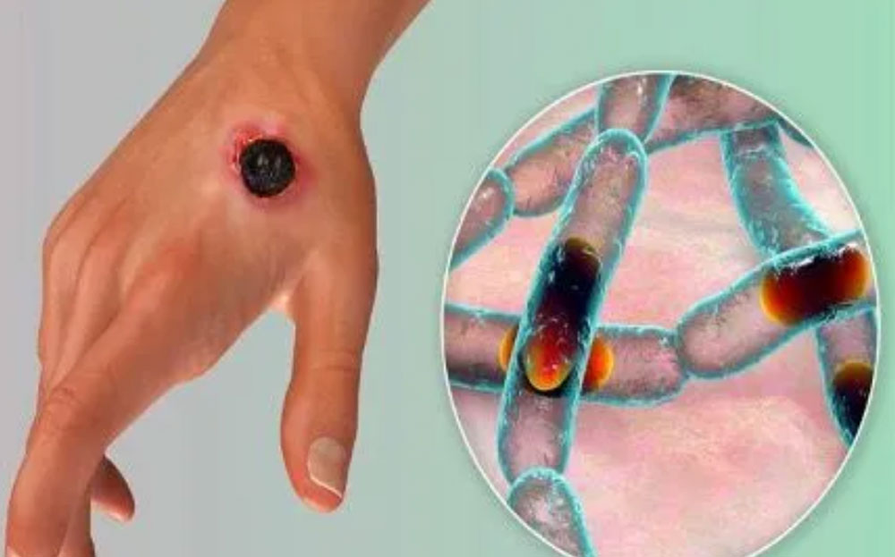 Bệnh than (anthrax) là một căn bệnh truyền nhiễm từ động vật do vi khuẩn Bacillus anthracis gây ra. (Ảnh minh họa)