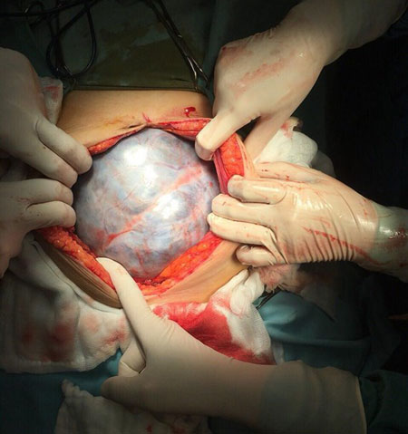 Hình ảnh khối u trong bụng bệnh nhân.