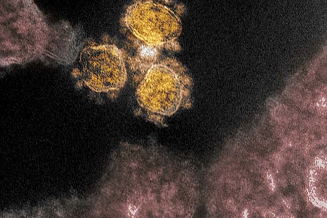 Virus SARS-CoV-2 phân lập từ tế bào cơ thể của bệnh nhân COVID-19 ở Mỹ. Ảnh minh họa.