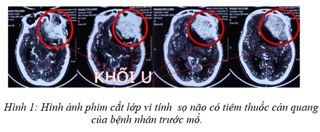 Hình ảnh phim cắt lớp vi tính sọ não có tiêm thuốc cản quang của bệnh nhân P.T.L trước khi mổ.