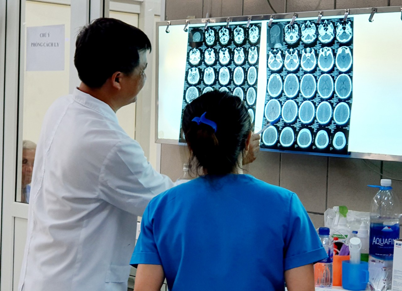 Hình ảnh phim chụp não bệnh nhân bị xuất huyết do ngộ độc ma túy đá.