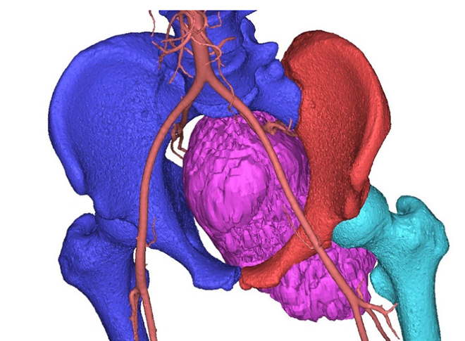 Một khối ung thư sụn (phần màu tím) trên hình ảnh 3D -