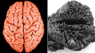 Bộ não 4.000 năm tuổi (phải) tương đối nguyên vẹn so với một bộ não bình thường.