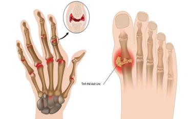 Nồng độ axit uric trong máu tăng cao là nguyên nhân hàng đầu gây ra bệnh gout.