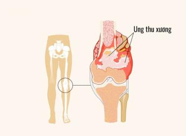 Osteosarcoma: bệnh ung thư xương nguyên phát phổ biến nhất, có nguồn gốc từ tế bào gốc tạo xương.