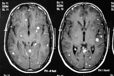 Hình ảnh các nốt tổn thương do bệnh lao trên não bệnh nhân.