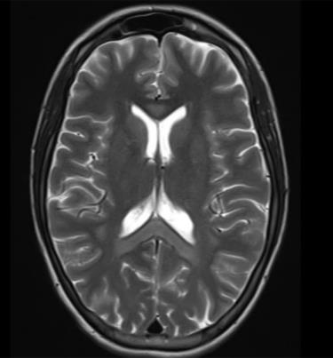 Hình ảnh chụp MRI sọ não bệnh nhân nữ bị tổn thương lan tỏa hai bán cầu và thể chai.