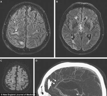 Chụp cộng hưởng từ (MRI) não bệnh nhân.