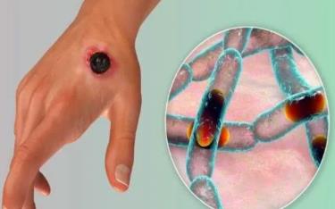 Bệnh than (anthrax) là một căn bệnh truyền nhiễm từ động vật do vi khuẩn Bacillus anthracis gây ra. (Ảnh minh họa)