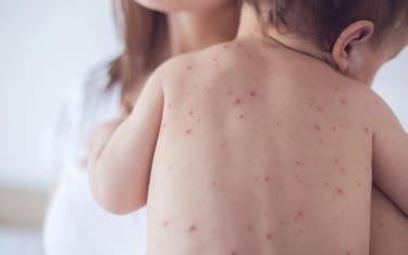 Nếu trong điều kiện không có biến chứng, các bậc phụ huynh có thể dễ dàng chăm sóc trẻ mắc sởi tại nhà