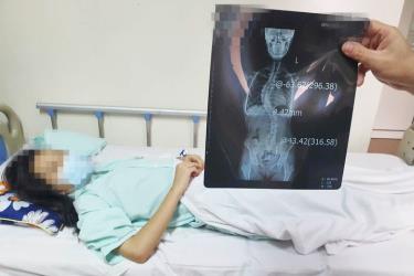 Một bệnh nhân có cột sống hình chữ S được điều trị tại Bệnh viện Hữu nghị Việt - Đức.