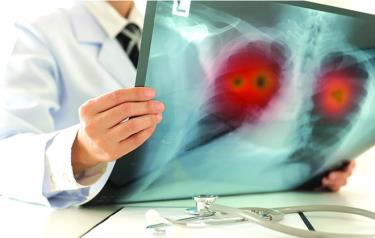 AI đang mở ra tiềm năng dự báo sớm nguy cơ đau tim và đột quỵ bằng cách sử dụng hình ảnh X-quang Ảnh: ADOBE