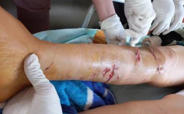 Các bác sĩ xử lý vết thương cho một trường hợp bị chó tấn công