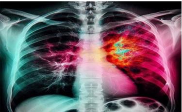 Nguyên nhân gây ra viêm phổi cộng đồng rất đa dạng, thông thường nhất là viêm phổi do vi khuẩn, virus.