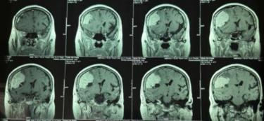 Hình ảnh khối u màng não 