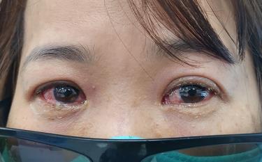 Các triệu chứng của bệnh đau mắt đỏ như mắt đỏ, tiết nhiều ghèn và chảy nước mắt sống.